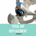 Read more about the article Must Know Knowledge: Total Hip Replacement (Arthroplasty) Surgery