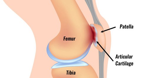 patellofemoral pain syndrome