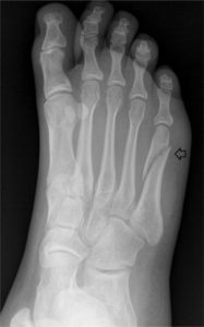 fractured foot