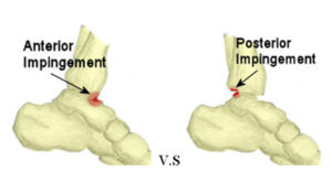 ankle impingement