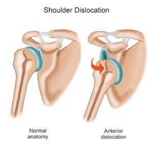 shoulder dislocation diagram