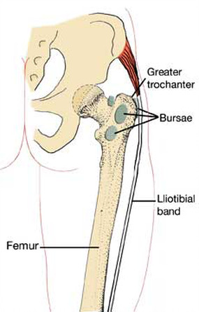 Greater trochanter pain syndrome