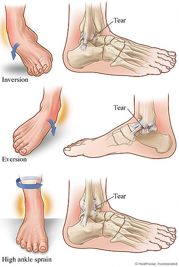 ankle sprain