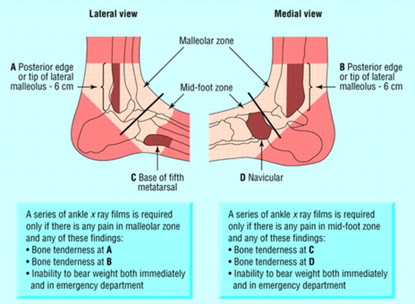 Why You Should See a Physiotherapist For Your Sprained Ankle - NRG