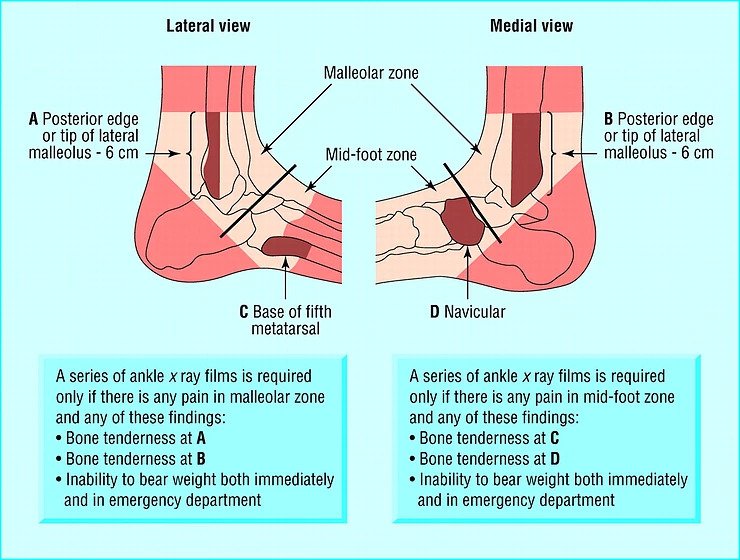 Broken Ankle  PhysioRoom Advice