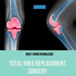 Read more about the article Must Know Knowledge: Total Knee Replacement (Arthroplasty) Surgery