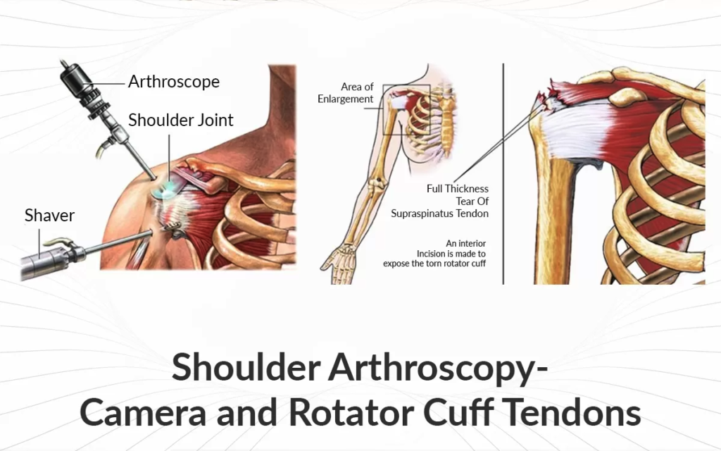 Understanding Your Options For Rotator Cuff Surgery