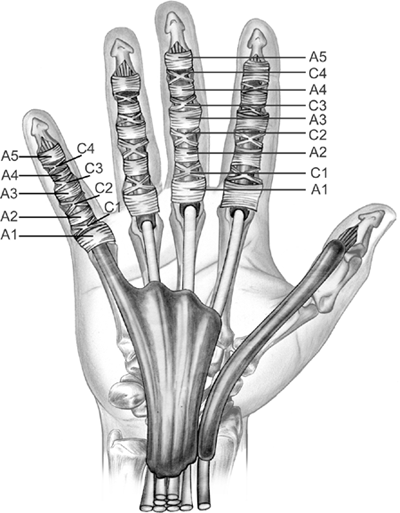 trigger finger treatment