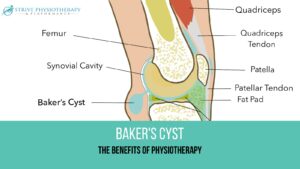 physiotherapy for bakers cyst kitchener