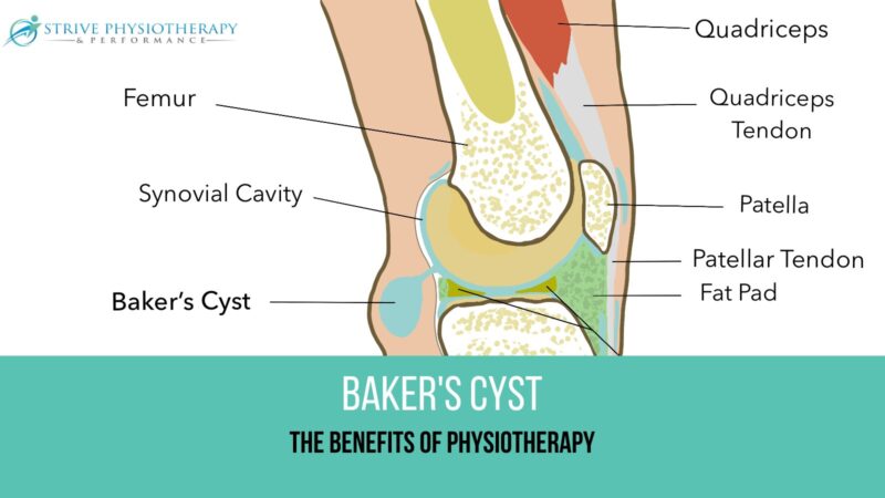 Exploring the Benefits of Physiotherapy for Baker's Cyst