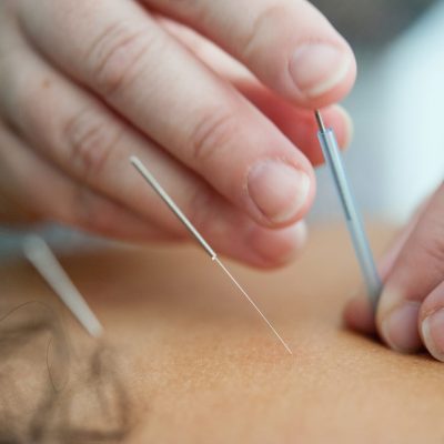 acupuncture kitchener