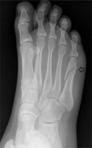 fractured foot