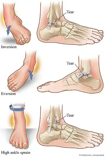 ankle sprain