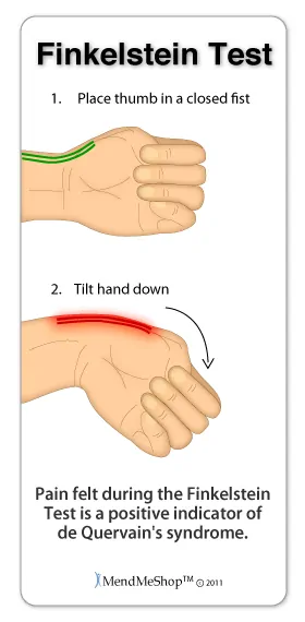de quervain's syndrome