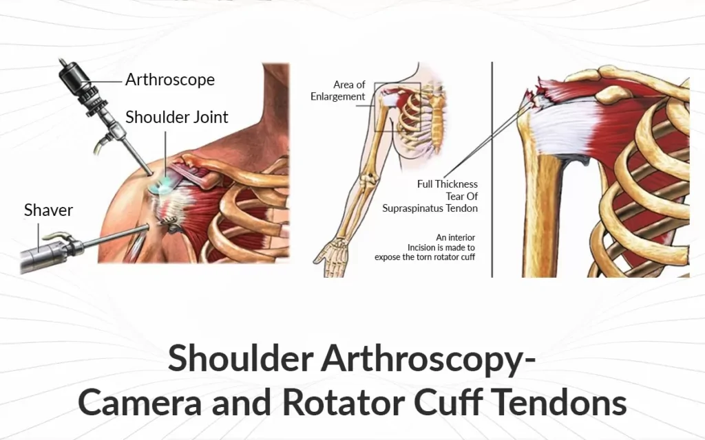 rotator cuff surgery